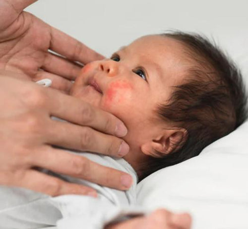 ATOPIČNA KOŽA UTICAJ KLIMATSKIH USLOVA I GODIŠNJIH DOBA - Mustela Multi-market - 1